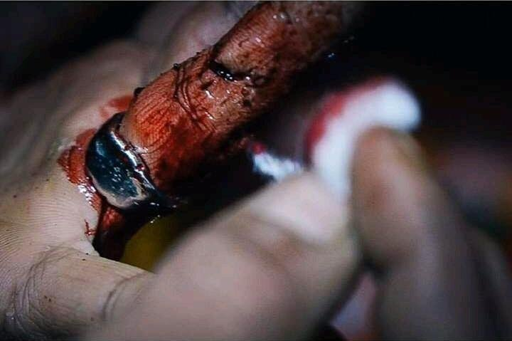 Survival: Moss for open wound
