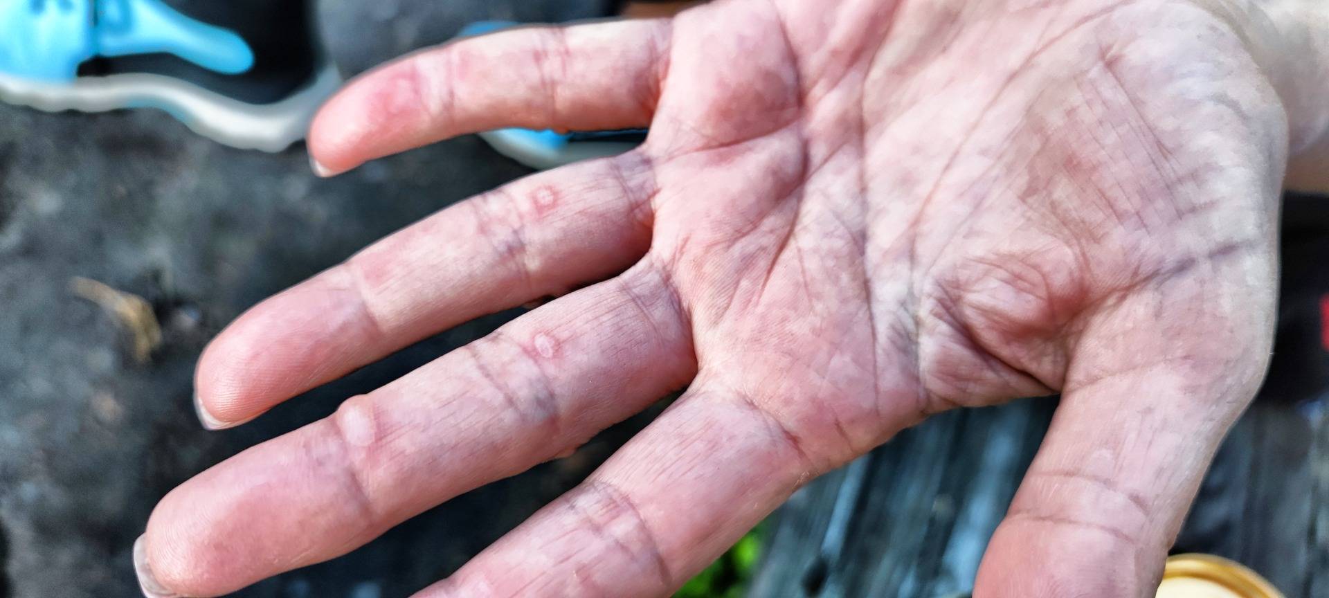 After a few days some hands are looking like this. Ouch.